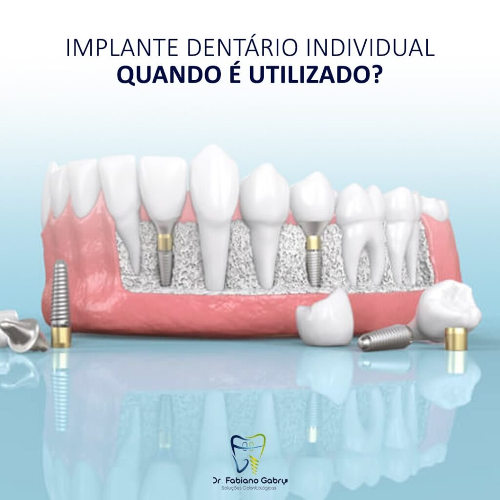 Implante dentário individual Dr Fabiano Gabry
