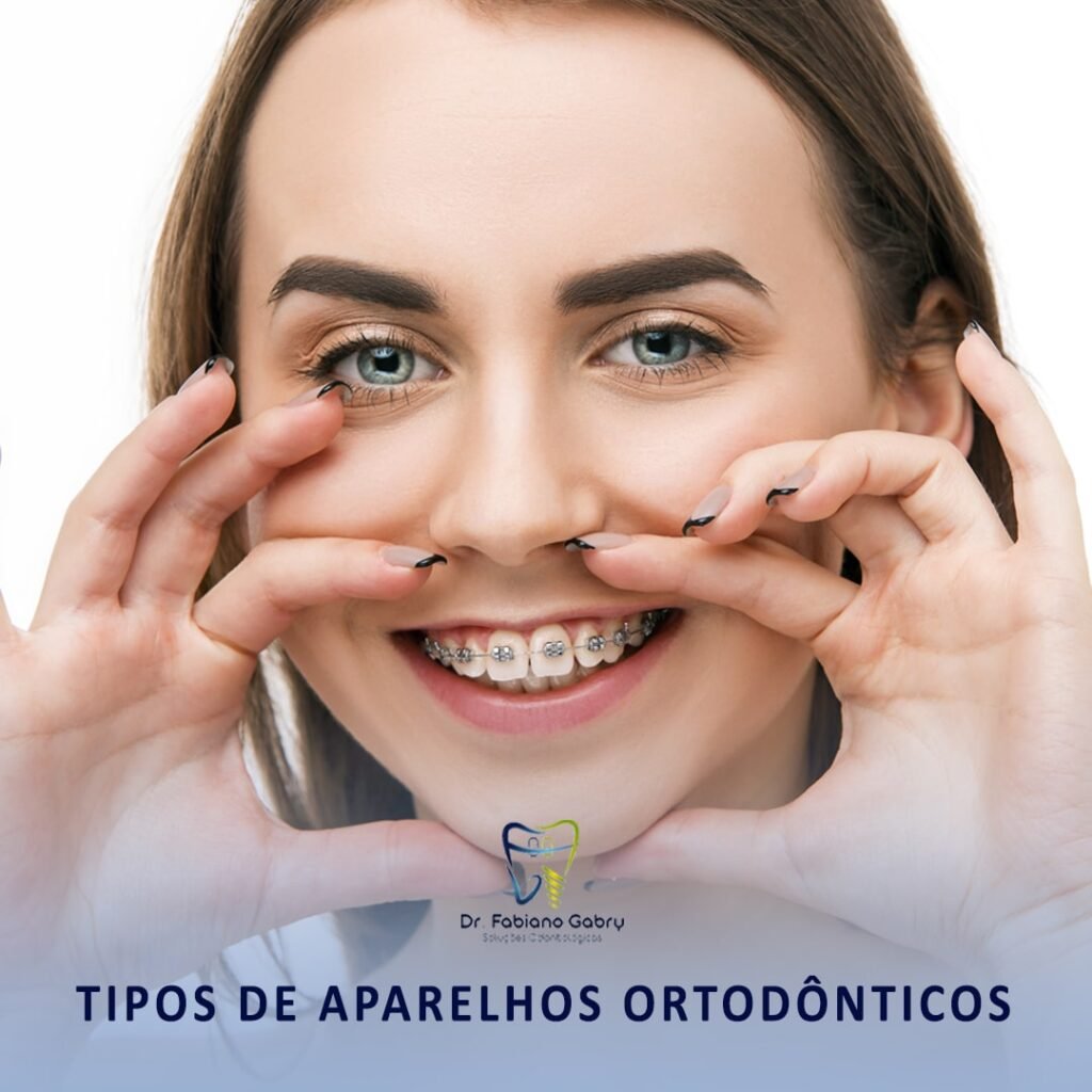 Tipos De Aparelhos Ortod Nticos Dr Fabiano Gabry